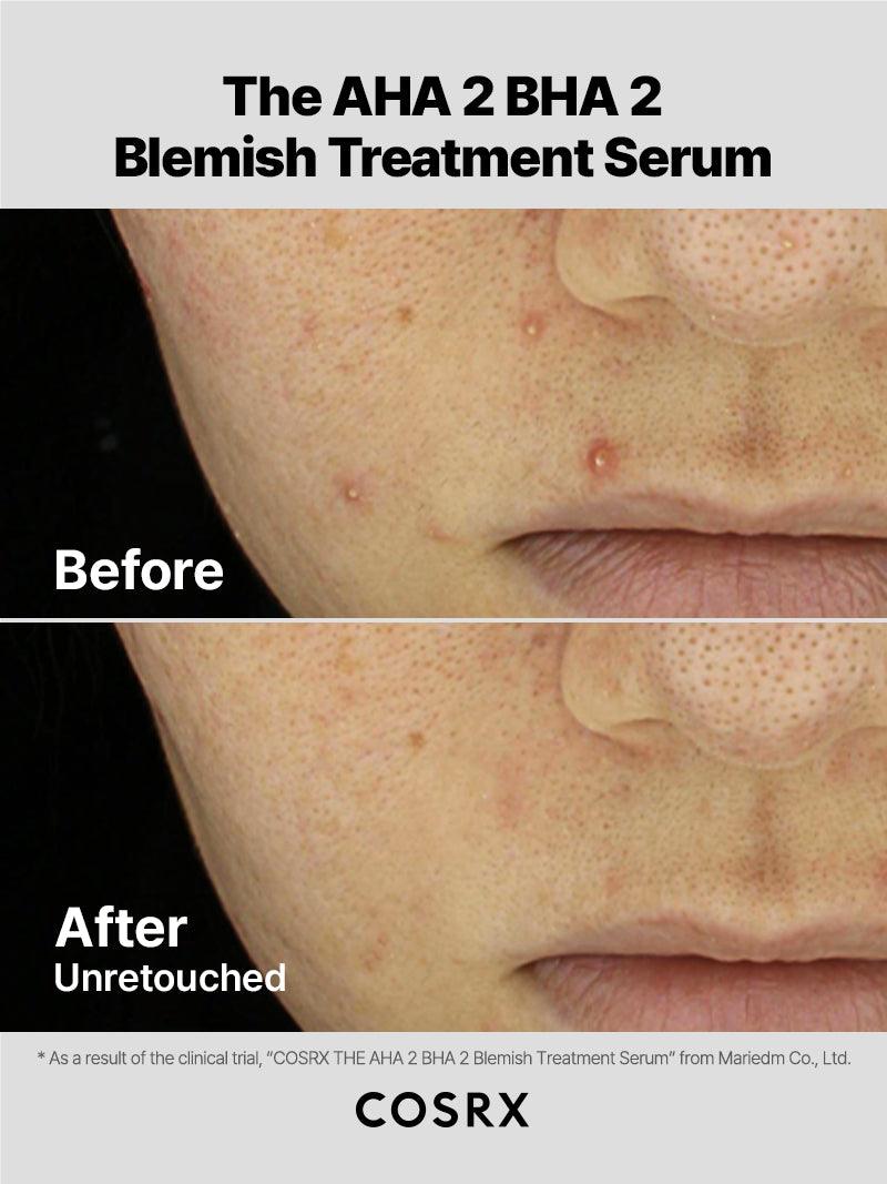 AHA2BHA2-Blemish-03-2-13956